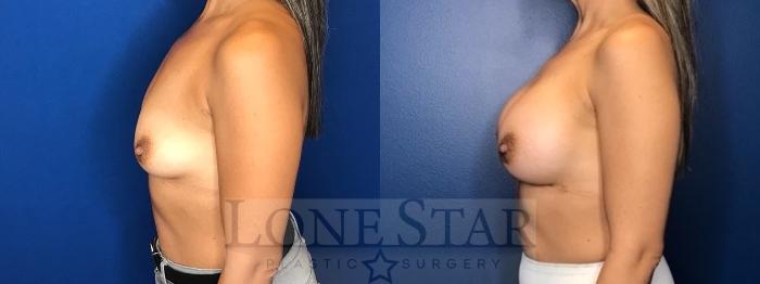 Before & After Breast Augmentation Case 69 Left Side View in Frisco, TX