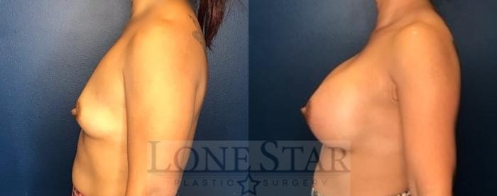 Before & After Breast Augmentation Case 77 Left Side View in Frisco, TX