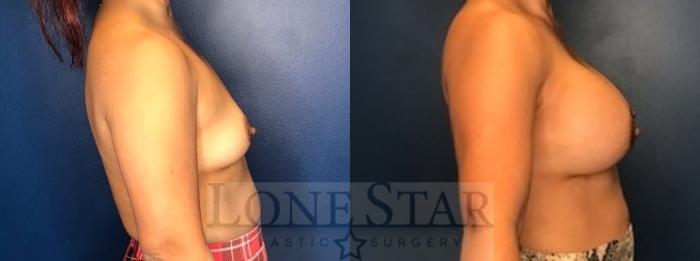 Before & After Breast Augmentation Case 77 Right Side View in Frisco, TX