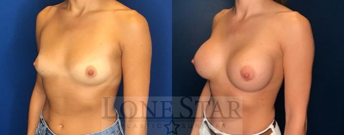 Before & After Breast Augmentation Case 79 Left Oblique View in Frisco, TX