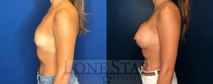 Before & After Breast Augmentation Case 79 Left Side View in Frisco, TX