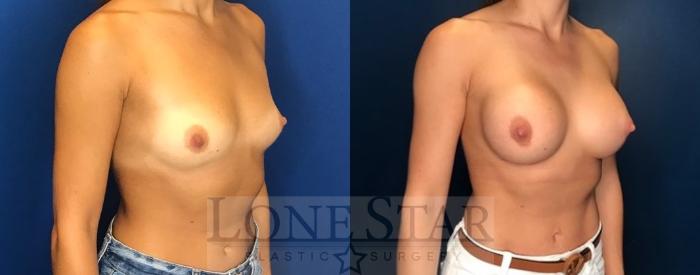 Before & After Breast Augmentation Case 79 Right Oblique View in Frisco, TX