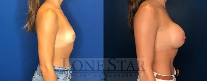 Before & After Breast Augmentation Case 79 Right Side View in Frisco, TX