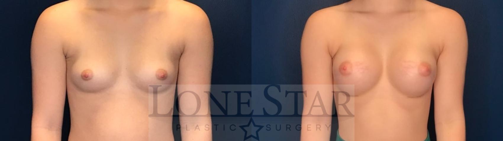 Before & After Breast Augmentation Case 83 Front View in Frisco, TX