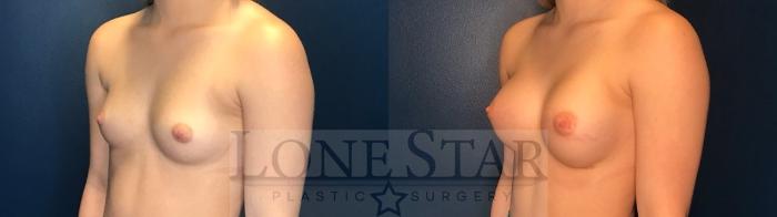 Before & After Breast Augmentation Case 83 Left Oblique View in Frisco, TX