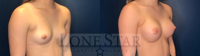 Before & After Breast Augmentation Case 83 Right Oblique View in Frisco, TX
