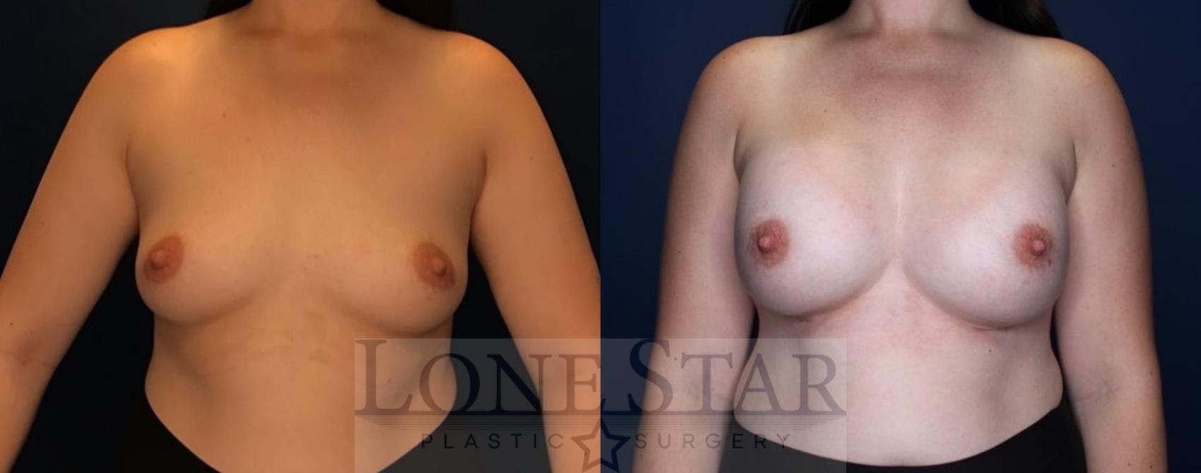 Before & After Breast Augmentation Case 86 Front View in Frisco, TX