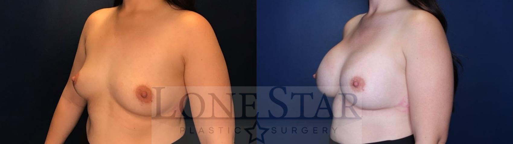 Before & After Breast Augmentation Case 86 Left Oblique View in Frisco, TX