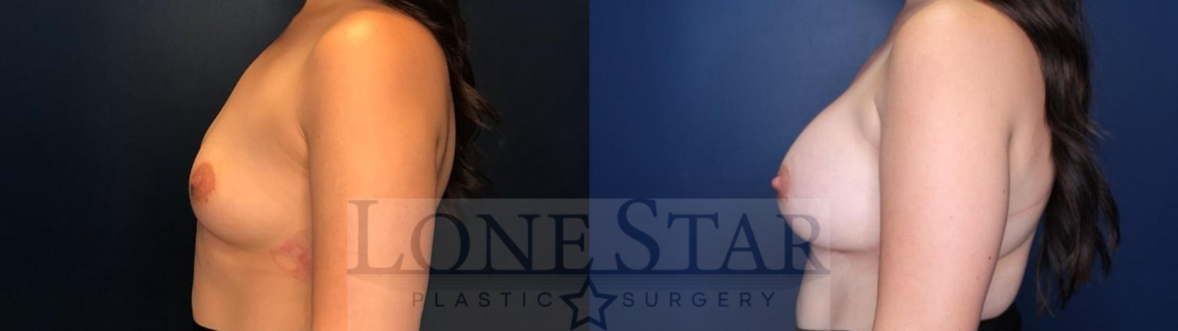 Before & After Breast Augmentation Case 86 Left Side View in Frisco, TX