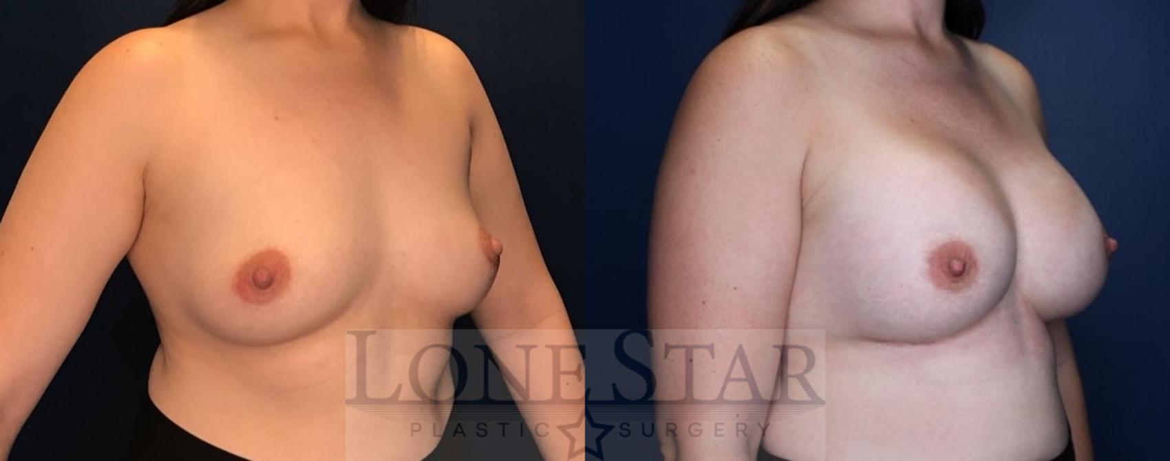 Before & After Breast Augmentation Case 86 Right Oblique View in Frisco, TX