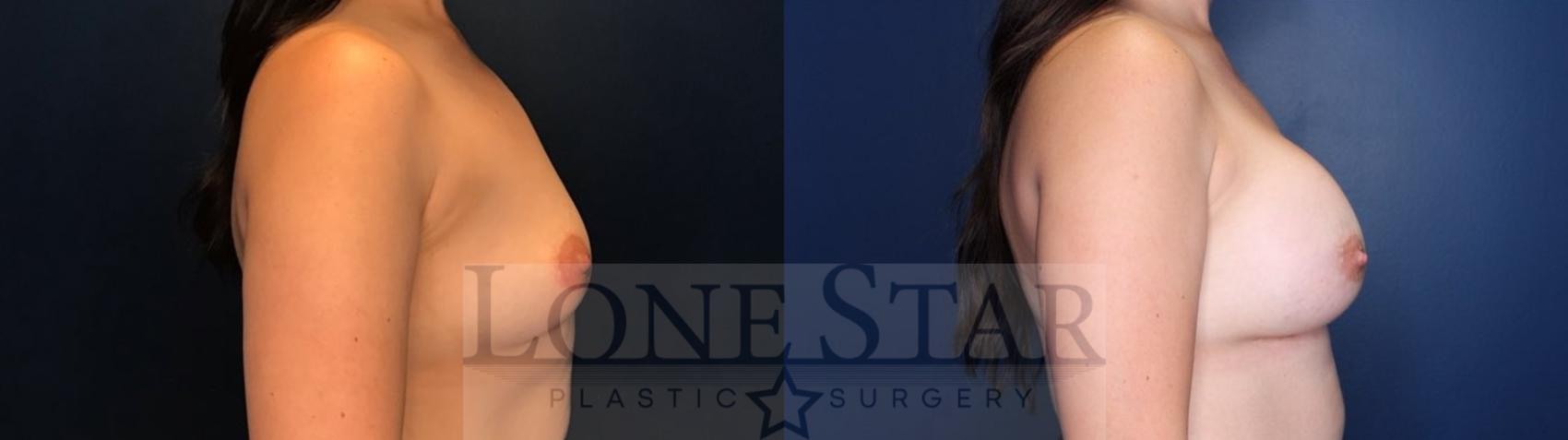 Before & After Breast Augmentation Case 86 Right Side View in Frisco, TX