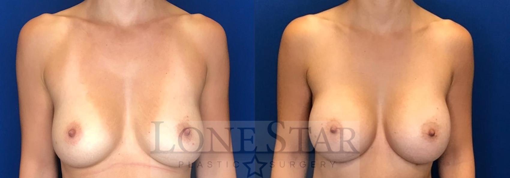 Before & After Breast Augmentation Case 98 Front View in Frisco, TX
