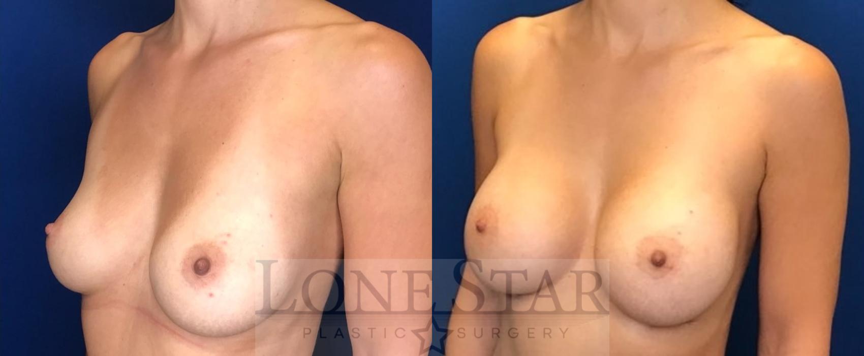 Before & After Breast Augmentation Case 98 Left Oblique View in Frisco, TX