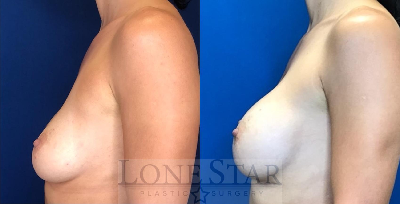 Before & After Breast Augmentation Case 98 Left Side View in Frisco, TX