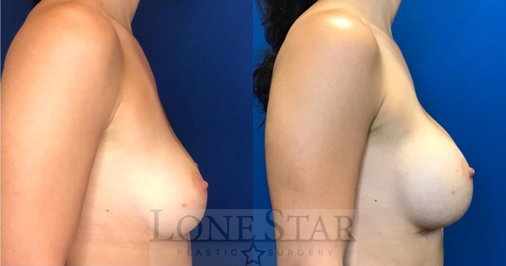 Before & After Breast Augmentation Case 98 Right Side View in Frisco, TX