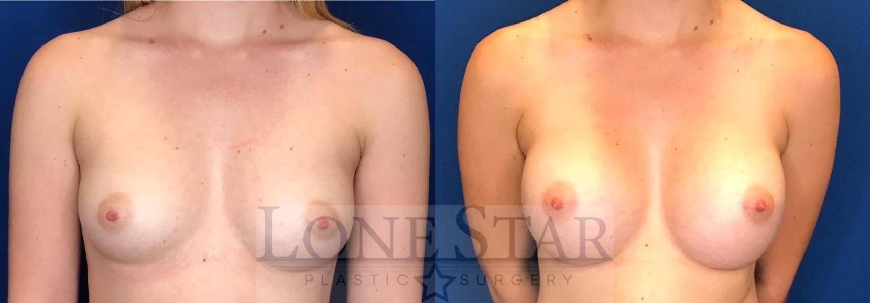 Before & After Breast Augmentation Case 99 Front View in Frisco, TX
