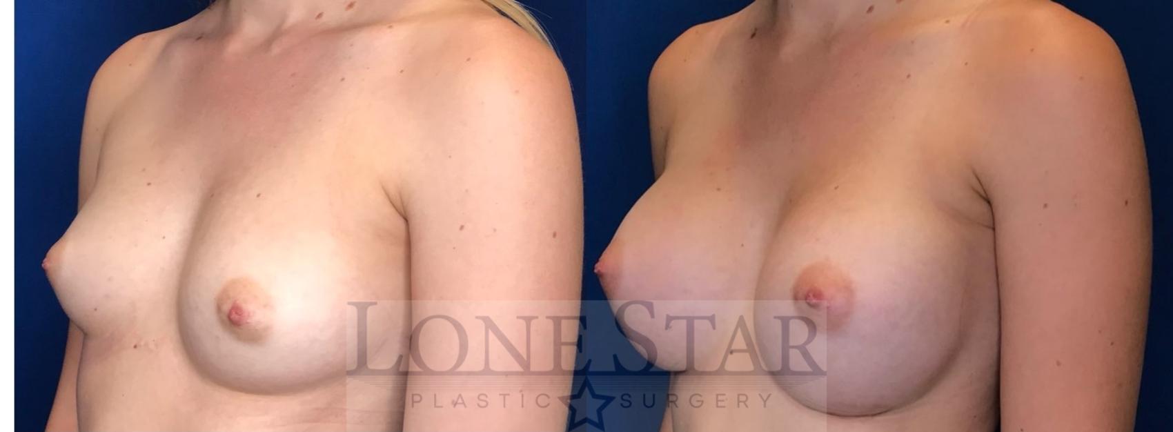 Before & After Breast Augmentation Case 99 Left Oblique View in Frisco, TX