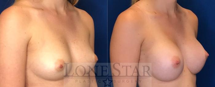Before & After Breast Augmentation Case 99 Right Oblique View in Frisco, TX