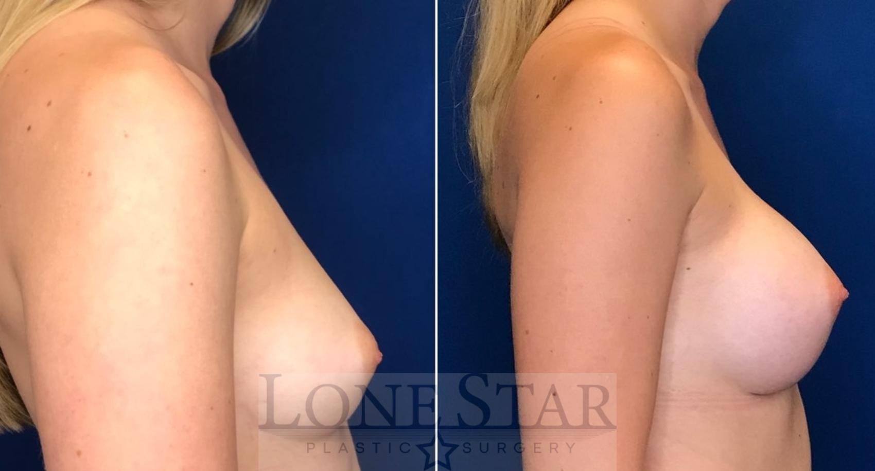 Before & After Breast Augmentation Case 99 Right Side View in Frisco, TX