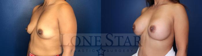 Before & After Breast Augmentation Case 147 Front View in Frisco, TX