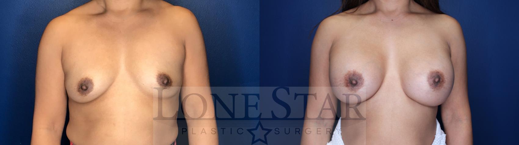 Before & After Breast Augmentation Revision Case 147 Right Side View in Frisco, TX