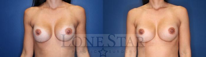 Before & After Breast Augmentation Case 174 Front View in Frisco, TX