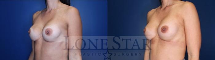 Before & After Breast Augmentation Case 174 Left Oblique View in Frisco, TX