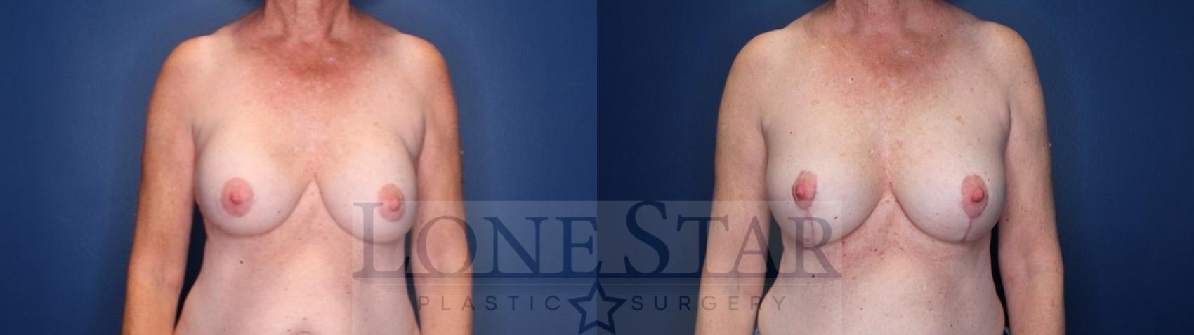 Before & After Breast Augmentation Revision Case 175 Front View in Frisco, TX