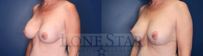 Before & After Breast Augmentation Revision Case 175 Left Oblique View in Frisco, TX
