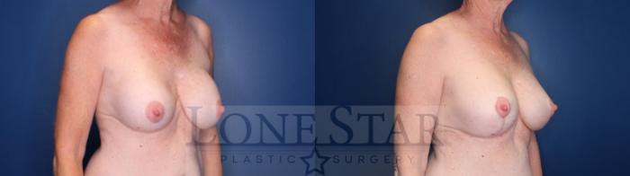 Before & After Breast Augmentation Case 175 Right Oblique View in Frisco, TX