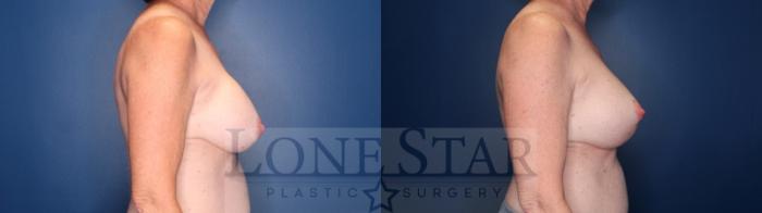 Before & After Breast Augmentation Revision Case 175 Right Side View in Frisco, TX