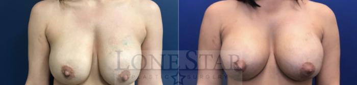 Before & After Breast Augmentation Revision Case 33 View #1 View in Frisco, TX