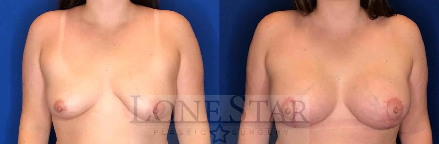 Before & After Breast Augmentation with Lift Case 103 Front View in Frisco, TX