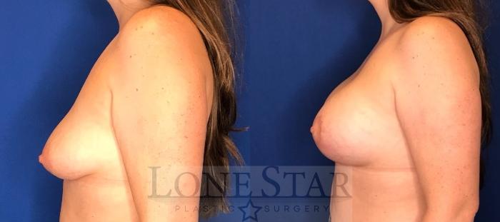 Before & After Breast Augmentation with Lift Case 103 Left Side View in Frisco, TX