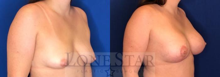 Before & After Breast Augmentation with Lift Case 103 Right Oblique View in Frisco, TX