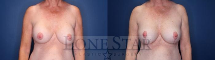 Before & After Breast Lift Case 136 Front View in Frisco, TX