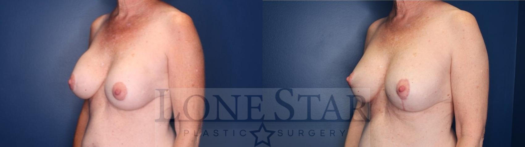 Before & After Breast Augmentation with Lift Case 136 Left Oblique View in Frisco, TX