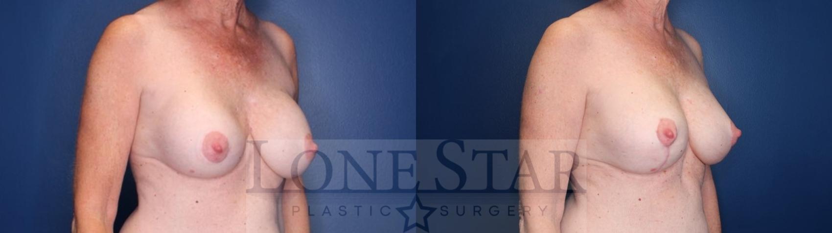 Before & After Breast Augmentation with Lift Case 136 Right Oblique View in Frisco, TX