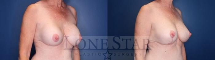 Before & After Breast Lift Case 136 Right Oblique View in Frisco, TX