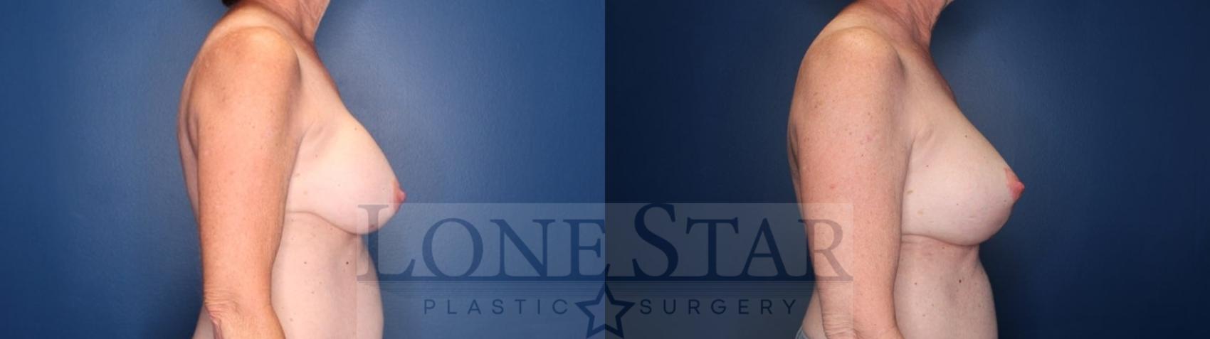Before & After Breast Augmentation with Lift Case 136 Right Side View in Frisco, TX