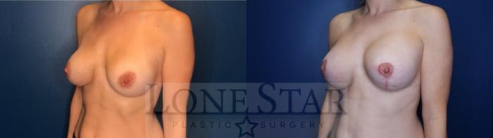 Before & After Breast Lift Case 137 Left Oblique View in Frisco, TX
