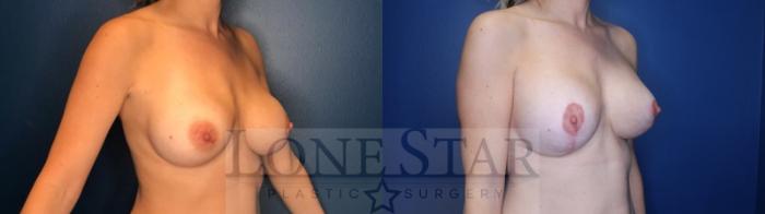 Before & After Breast Lift Case 137 Right Oblique View in Frisco, TX