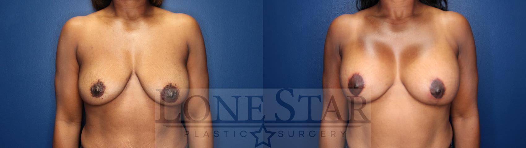 Before & After Breast Augmentation with Lift Case 150 Front View in Frisco, TX