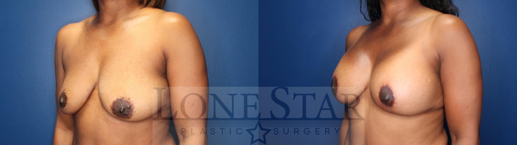 Before & After Breast Augmentation with Lift Case 150 Left Oblique View in Frisco, TX