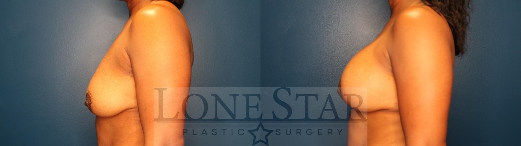 Before & After Breast Augmentation with Lift Case 150 Left Side View in Frisco, TX