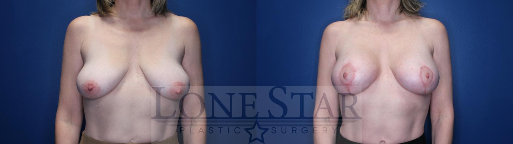 Before & After Breast Augmentation Case 151 Front View in Frisco, TX