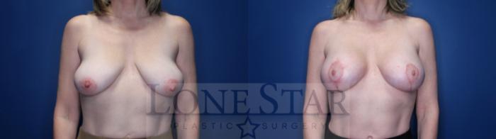 Before & After Breast Lift Case 151 Front View in Frisco, TX