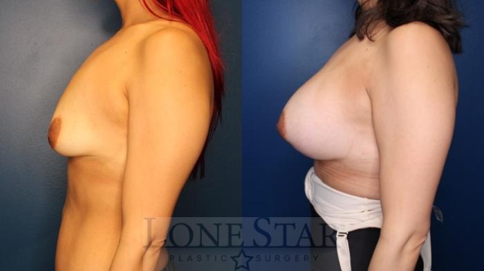 Before & After Breast Augmentation Case 167 Left Side View in Frisco, TX