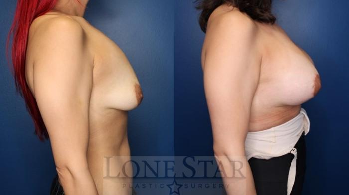 Before & After Breast Augmentation with Lift Case 167 Right Side View in Frisco, TX