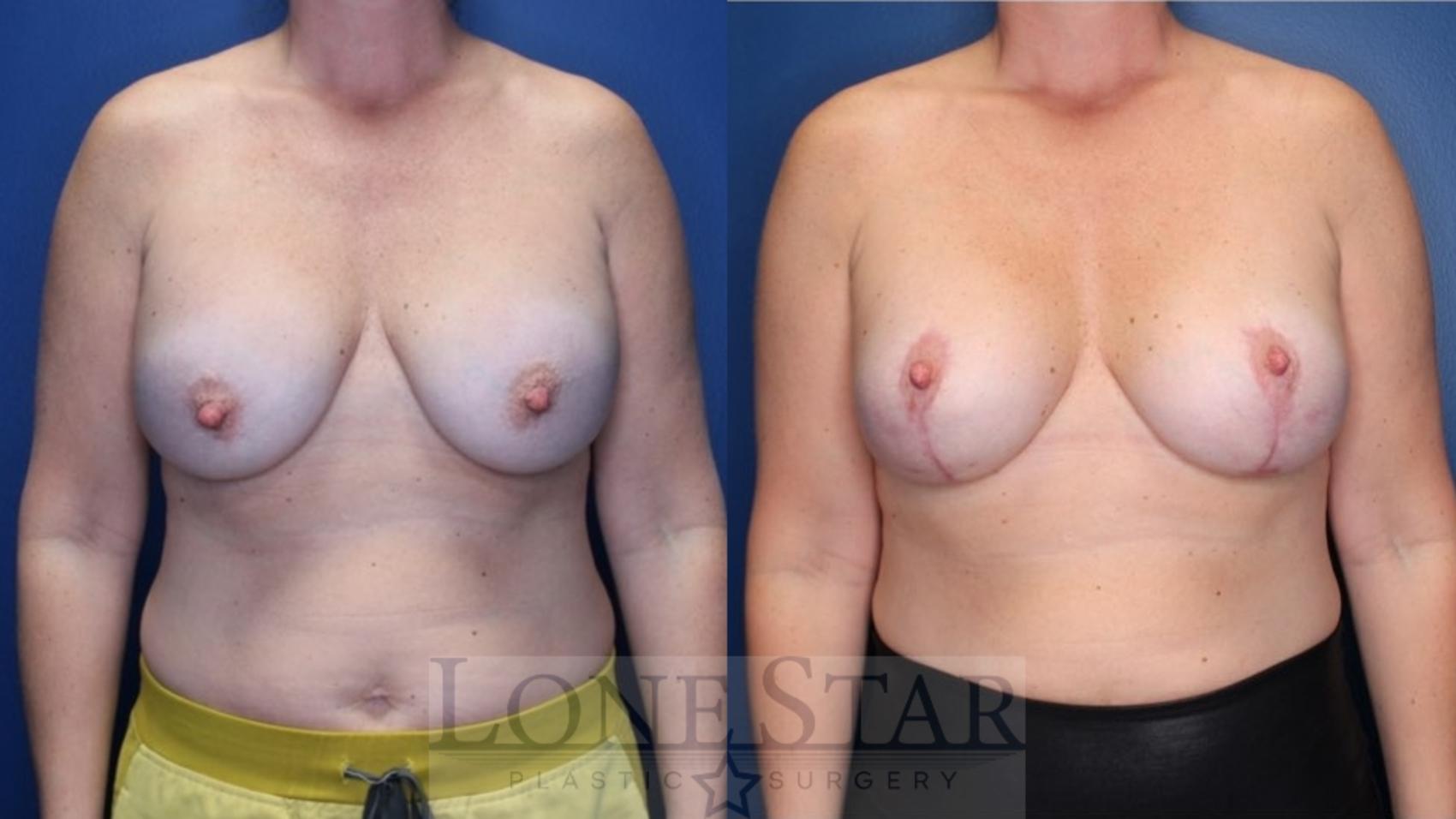 Before & After Breast Augmentation with Lift Case 169 Front View in Frisco, TX
